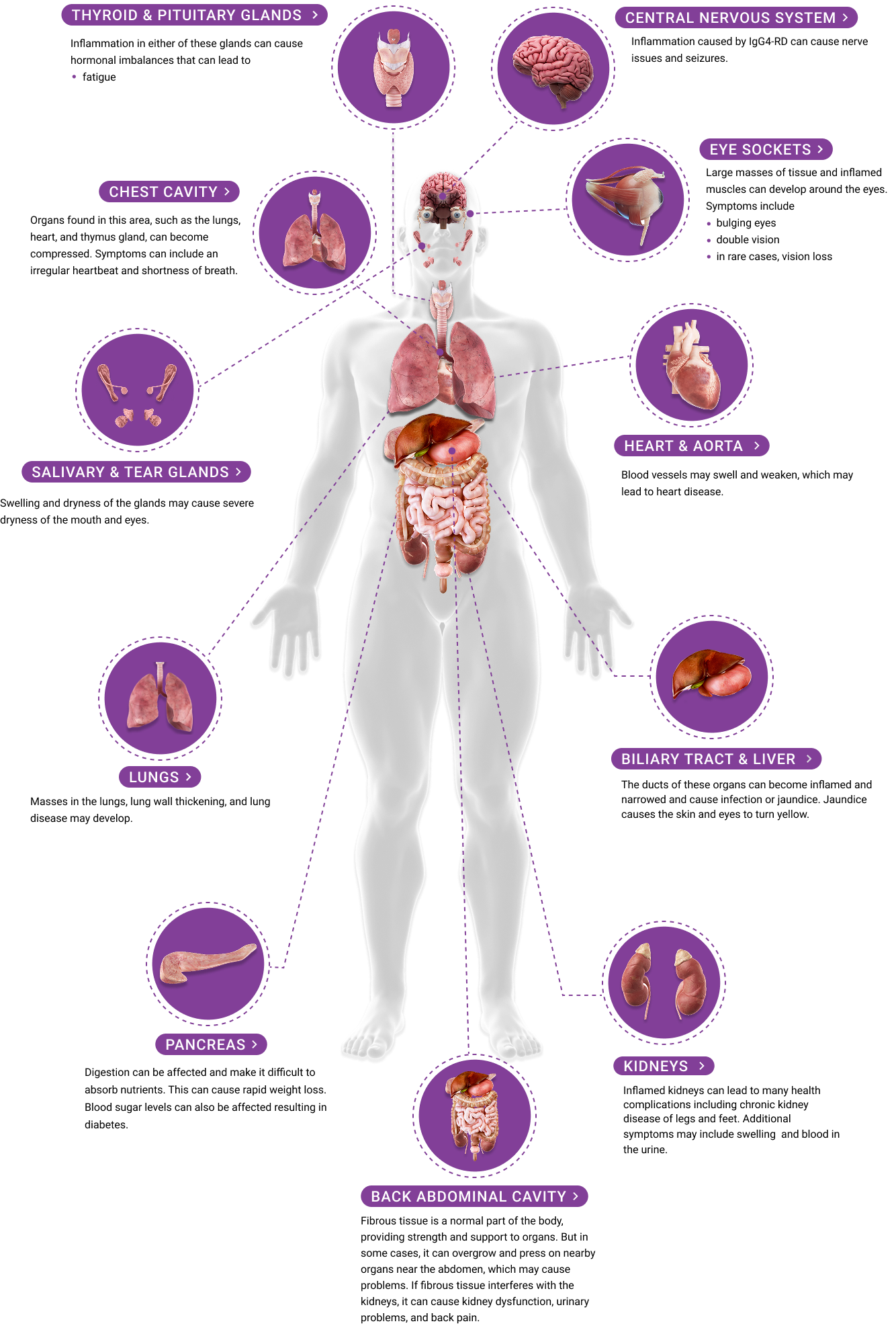 IgG4-related disease symptoms graphic